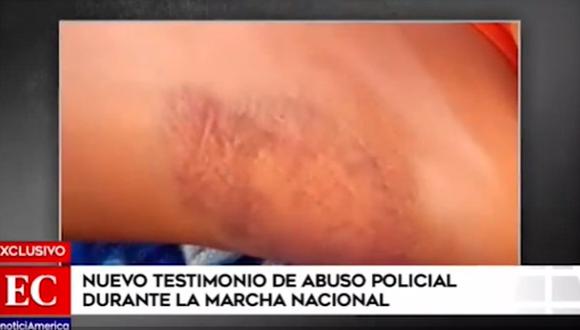 Mujer mostró las heridas que presuntamente fueron producto de la represión policial (América)