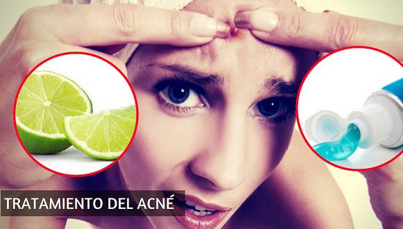 Remedios caseros para el acné rápidos y efectivos (tratamiento natural para  el acné) | SALUD | CORREO