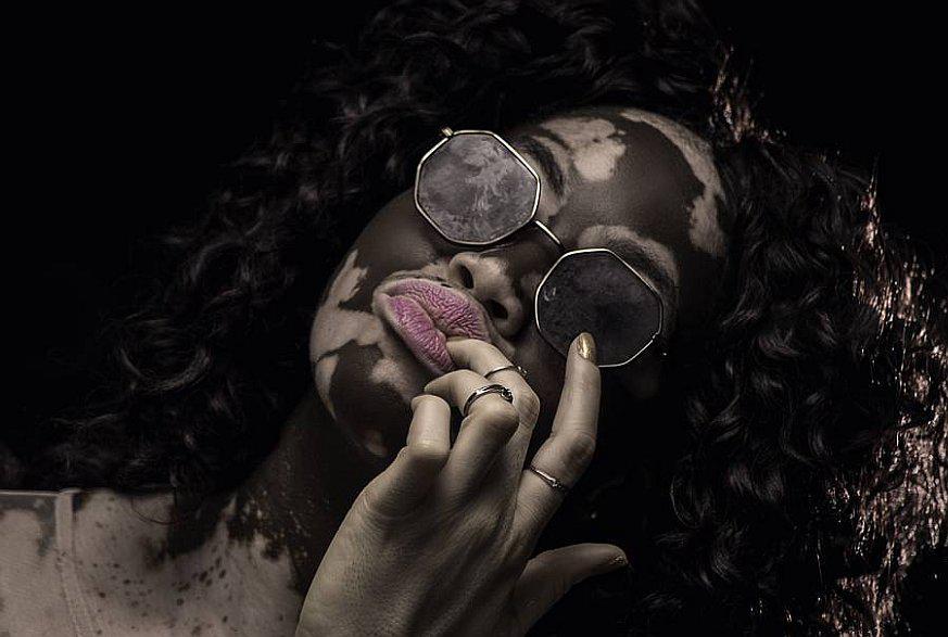 La historia de la enfermera con vitíligo que superó el bullying y se convirtió en modelo