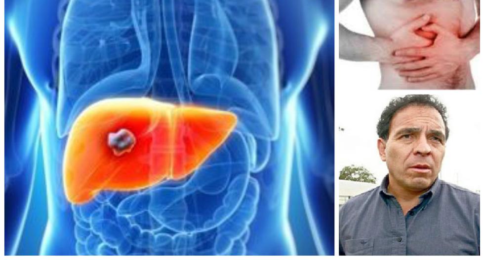 Salud Conoce los signos y síntomas del cáncer de hígado DEPORTES