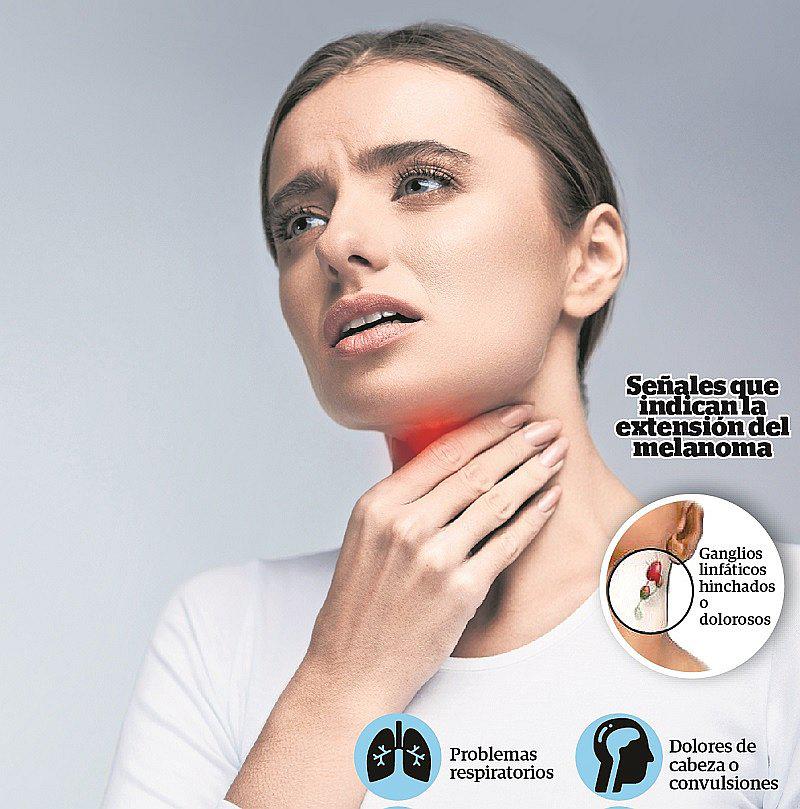 Melanoma metastásico: un tipo de cáncer de piel