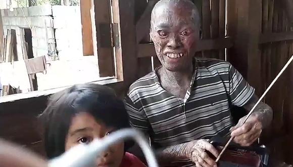 La impactante vida del hombre pez de Filipinas y su lucha por salir adelante [VIDEO]