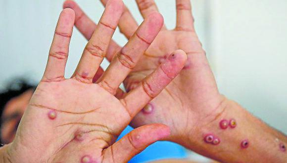155 casos se registran en Trujillo, cuatro de Ascope y uno de Pacasmayo. Según entidad sanitaria, vacuna puede evitar que desarrolle forma severa de monkeypox.