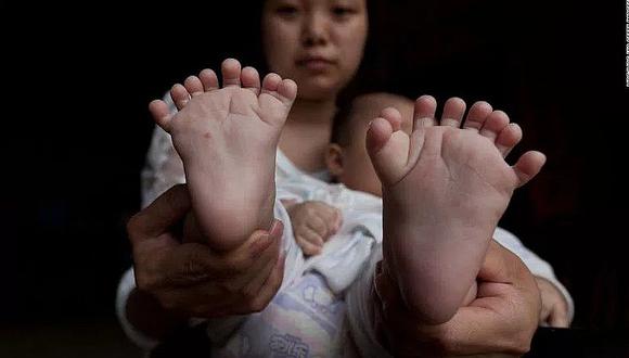 Nace niño con 31 dedos en manos y pies