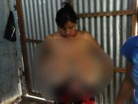 Mujer pide apoyo para operarse malformación en los senos