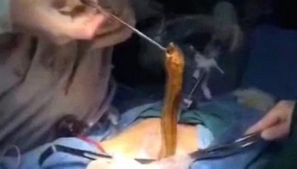 Médicos extirpan anguila del intestino de un chino que la usó contra el estreñimiento [VIDEO]