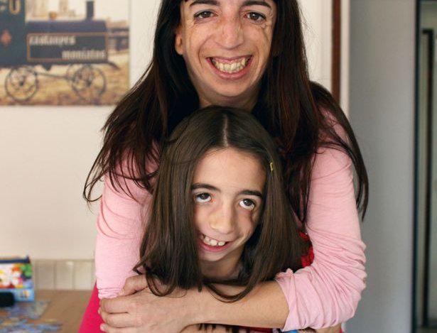 YouTube: Madre e hija sobrellevan la misma malformación