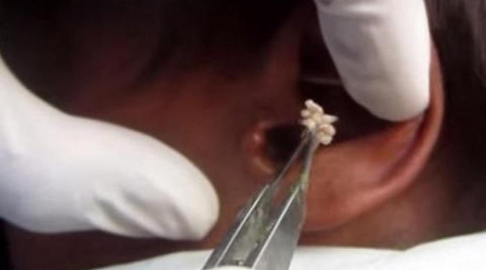  Doctor saca cientos de gusanos de oído de paciente (VIDEO)