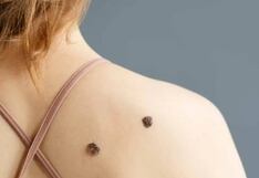 Lesión cutánea: Qué es, cómo detectarla y cuándo extirparla