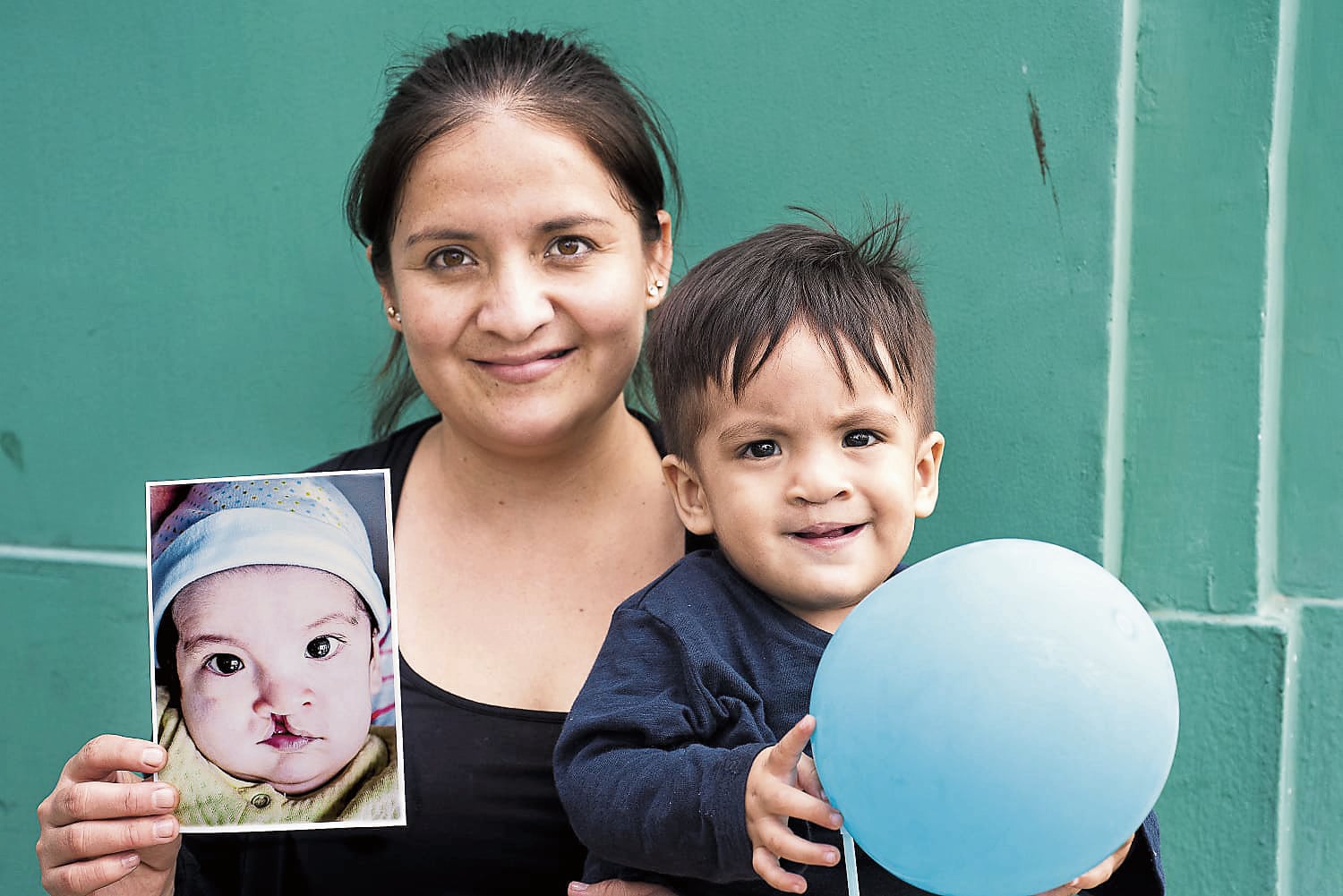 Cirugías gratuitas para recuperar sonrisas de niños y adultos con labio fisurado en Arequipa