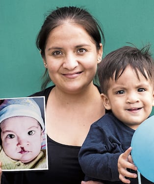Cirugías gratuitas para recuperar sonrisas de niños y adultos con labio fisurado en Arequipa