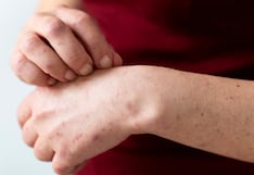 Juliaca registra dos casos confirmados de sarampión, entre ellos un niño de cuatro años