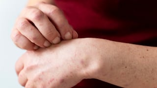 Juliaca registra dos casos confirmados de sarampión, entre ellos un niño de cuatro años