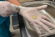 Huánuco: Médicos salvan la vida de niño que tenía moneda atorada en la garganta