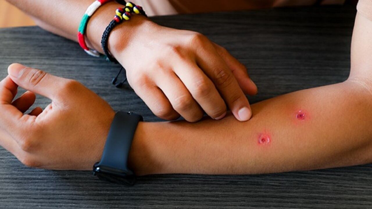 Minsa registró más de 3500 casos de cáncer de piel del 2021 al 2023