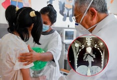 Lima: Médicos salvan la vida a niña de 12 años tras extraerle una piedra de 6 centímetros