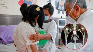 Lima: Médicos salvan la vida a niña de 12 años tras extraerle una piedra de 6 centímetros