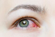 Conjuntivitis en verano: ¿Cómo evitarla? Recomendaciones de un oftalmólogo