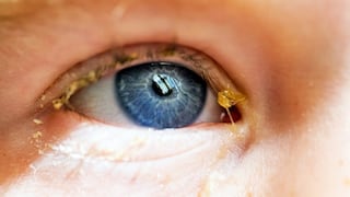 ¿Qué son las legañas y cuándo pueden indicar un problema de salud ocular?