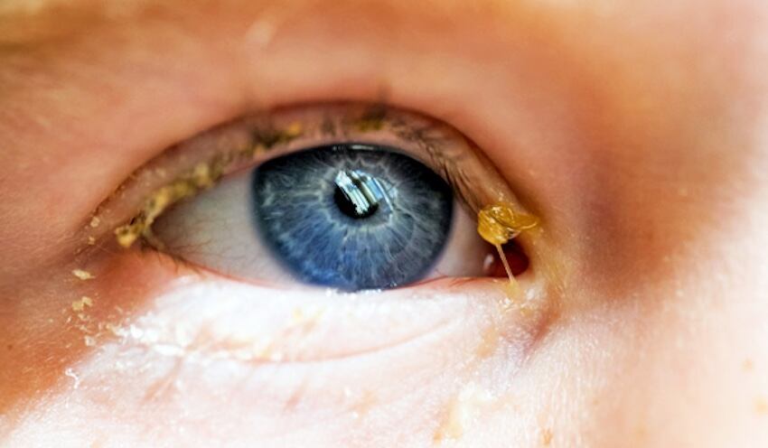 Aunque suelen ser una secreción normal al despertar, cambios en el color, cantidad o frecuencia de las legañas pueden alertar sobre afecciones como ojo seco, conjuntivitis o blefaritis.