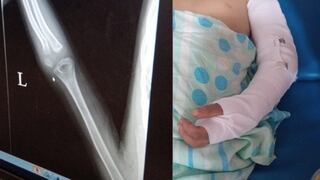 Ica: madre denuncia fractura de brazo de su hijo en colegio y ahora requiere operación