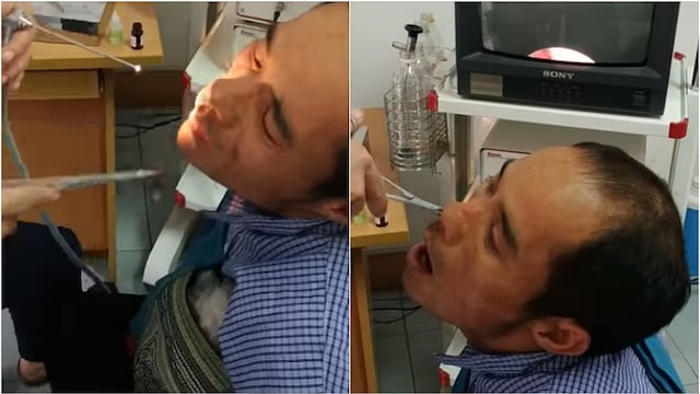 El extraño hallazgo de un médico en la fosa nasal de un paciente (VIDEO) 