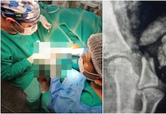 Nasca: Hospital Ricardo Cruzado Rivarola salva pulgar de paciente en exitosa cirugía de alta complejidad