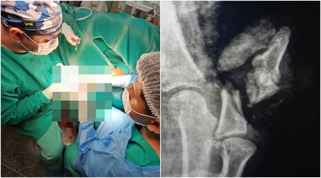 Nasca: Hospital Ricardo Cruzado Rivarola salva pulgar de paciente en exitosa cirugía de alta complejidad