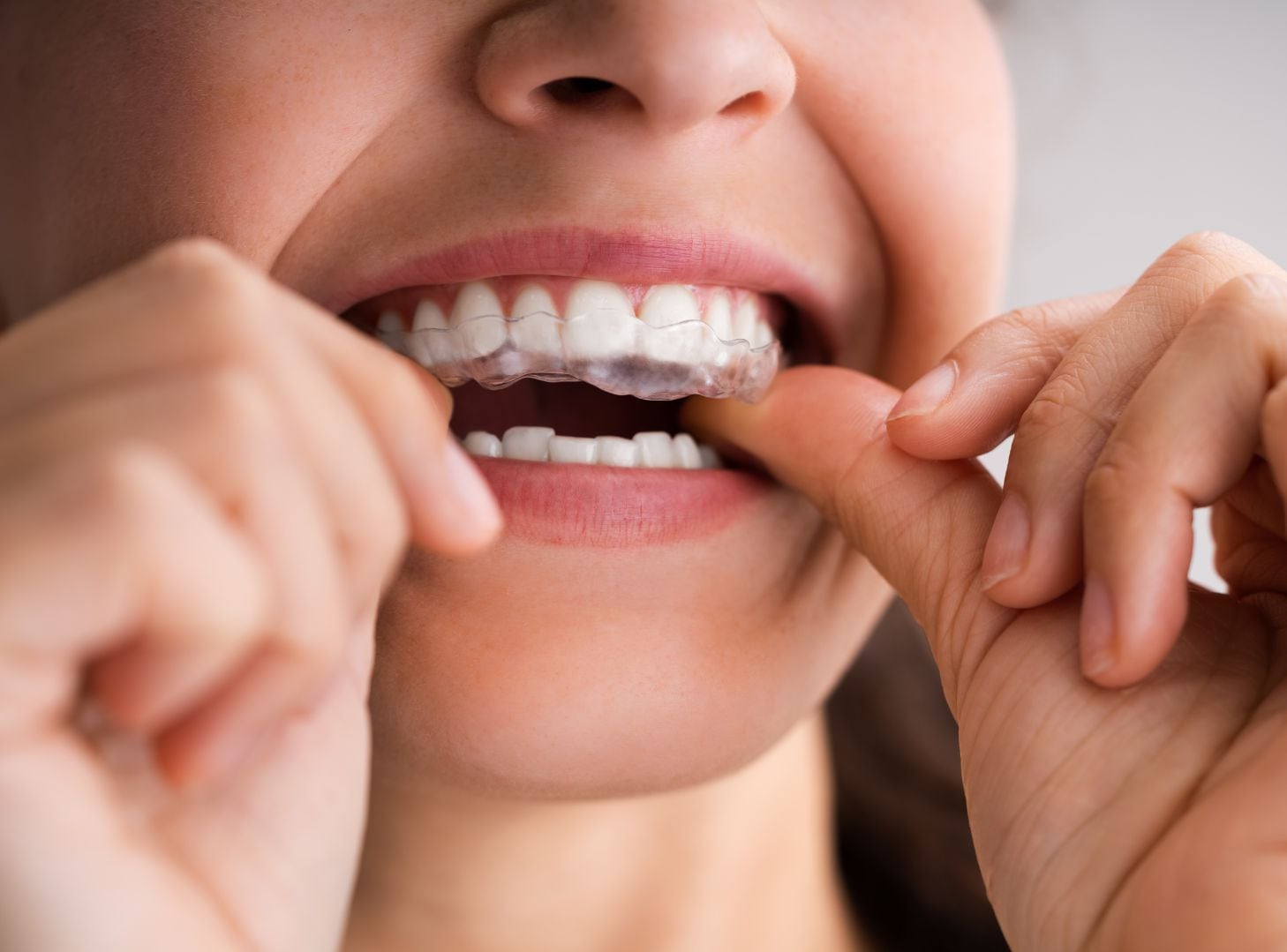 Apretar o rechinar los dientes puede ocurrir tanto durante el sueño como mientras una persona está despierta. El desgaste dental, dolor mandibular y fracturas son algunas de sus posibles consecuencias.