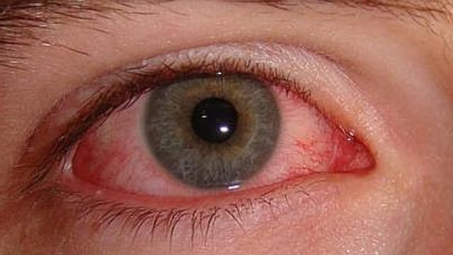 Zika provoca inflamación dentro de los ojos