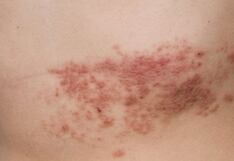 Herpes Zóster, una enfermedad silenciosa y dolorosa que se puede prevenir