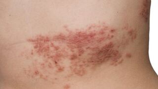 Herpes Zóster, una enfermedad silenciosa y dolorosa que se puede prevenir
