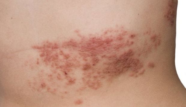 Más del 95% de los adultos mayores de 50 años portan el virus del herpes zóster. Pese a no ser mortal, causa dolor intenso y lesiones cutáneas. Por ello, expertos destacan la vacunación como un factor clave para evitar sus complicaciones.