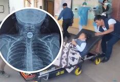 Cusco: Niña se traga moneda de un sol en su primer día de clases y tuvo que ser operada de emergencia (VIDEO)