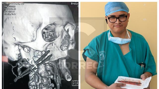 Después de 150 minutos cirujano retira palo que perforó cabeza de ex edil
