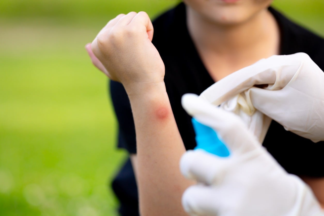 Durante el feriado de Semana Santa, especialistas recomiendan conocer medidas básicas de primeros auxilios para actuar ante emergencias frecuentes en playas y actividades al aire libre.