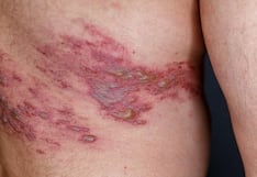 Herpes zóster después de los 50 años: síntomas, riesgos y complicaciones que debes conocer