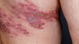 Herpes zóster después de los 50 años: síntomas, riesgos y complicaciones que debes conocer