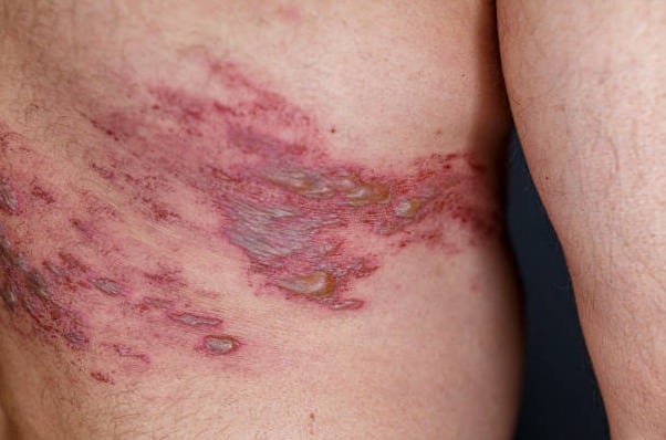 La reactivación del virus que causa la varicela puede provocar una erupción dolorosa y complicaciones que afectan la calidad de vida. Especialistas destacan la importancia de reconocer las señales y buscar atención médica oportuna.