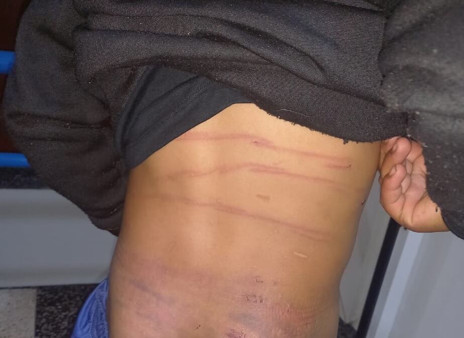 Así quedó el niño agredido por personas mayores, con profundas marcas. El hecho no debe quedar impune