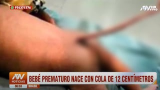 Bebé nació con cola de 12 centímetros en Brasil y causó asombro en médicos 