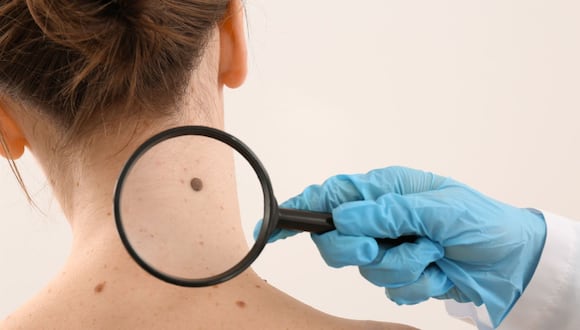 La Organización Mundial de la Salud (OMS) calcula que cada año ocurren entre dos y tres millones de nuevos casos de cáncer de piel en el mundo.