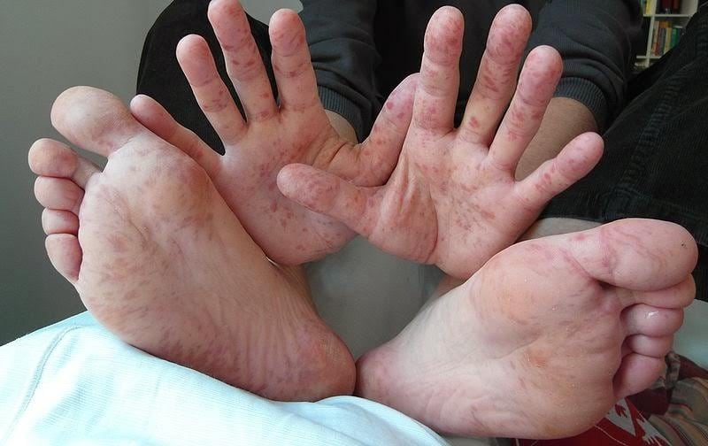 Un total de 577 casos del virus de pies, manos y boca en la región Junín