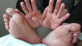 Junín: 79 casos del virus de pies manos y boca durante el 2025