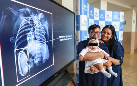 EsSalud: Realizan primer implante de marcapaso en bebé prematura de Latinoamérica