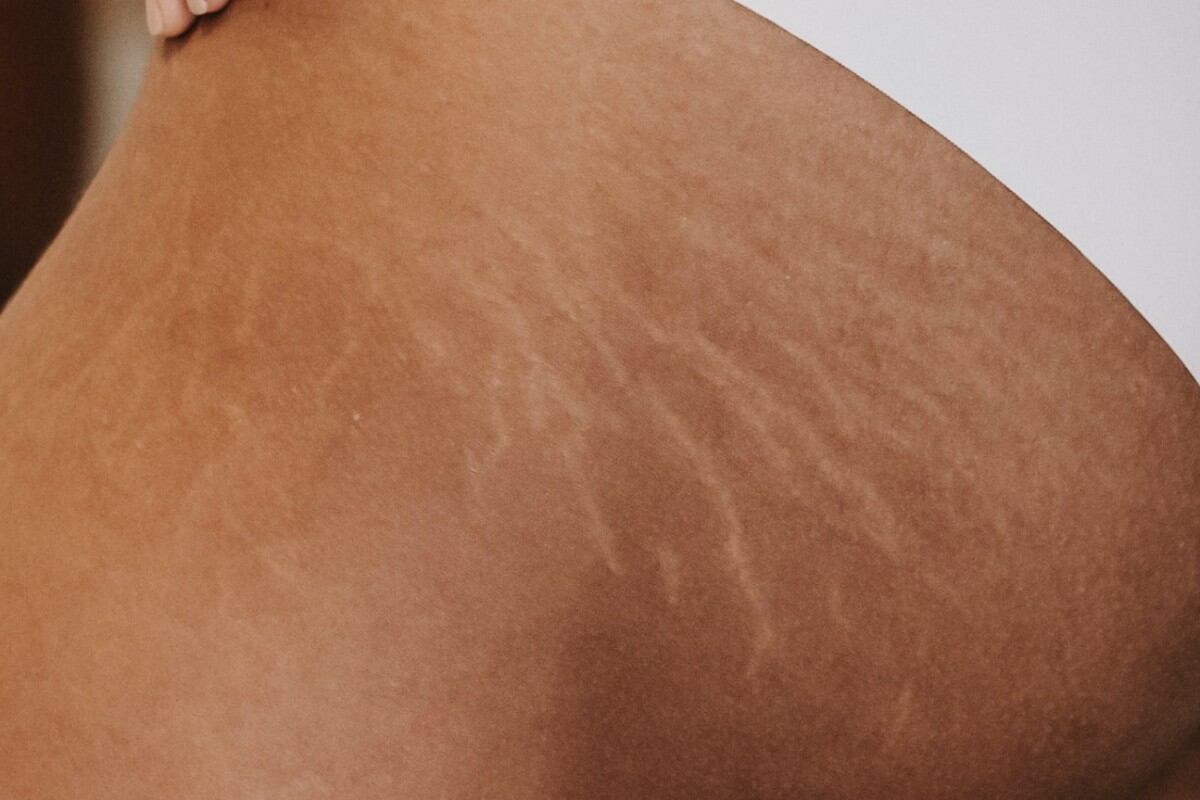 Como opción estética, el camuflaje de estrías ayuda a regenerar la piel de forma natural y produce cambios positivos en la autoestima. Sin embargo, insiste, “las estrías no se eliminan”. (Foto: Pexels)