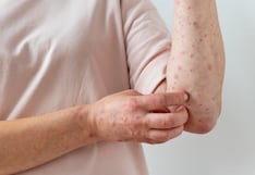 Casos de sarampión en aumento: síntomas, riesgos y cómo prevenir el contagio