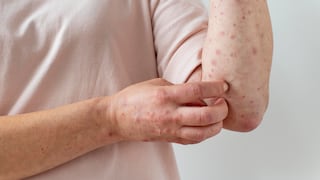 Casos de sarampión en aumento: síntomas, riesgos y cómo prevenir el contagio