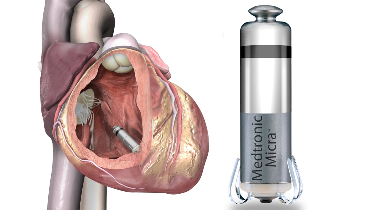 Los nuevos marcapasos intracardíacos eliminan cables —principal causa de complicaciones— y permiten una recuperación rápida. El dispositivo puede durar hasta 17 años implantado. (Imágenes de Medtronic)