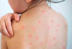 Perú enfrenta alertas sanitarias por sarampión y virus respiratorio en menores